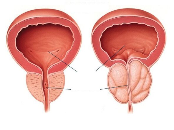 próstata normal e agrandada
